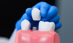 The Complete Guide to Dental Implants