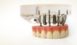 How Long Does It Take To Get Dental Implants?
