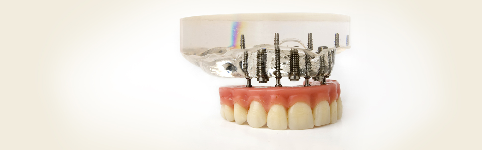 How Long Does It Take To Get Dental Implants?