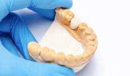 Top Benefits of Dental Crowns in Bay City, TX