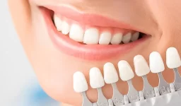How Long Does It Take to Get Veneers from Start to Finish?