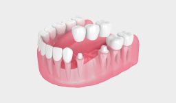 How Dental Bridges Can Stop Shifting Teeth and Bite Problems