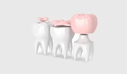 An Ultimate Guide to Dental Inlays & Onlays